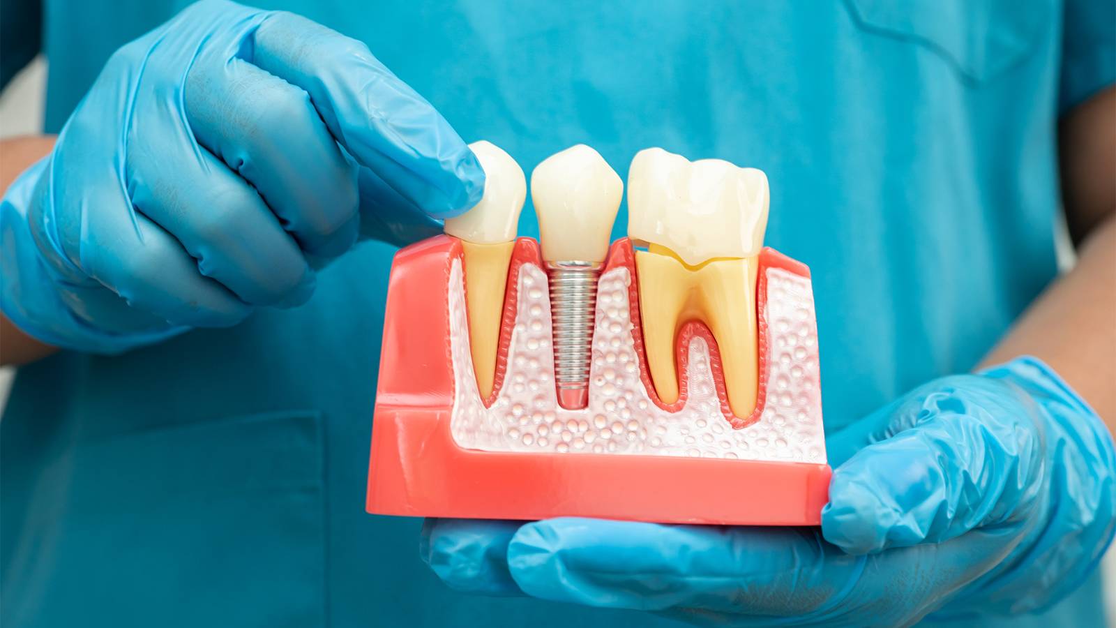 All-on-4 Implant