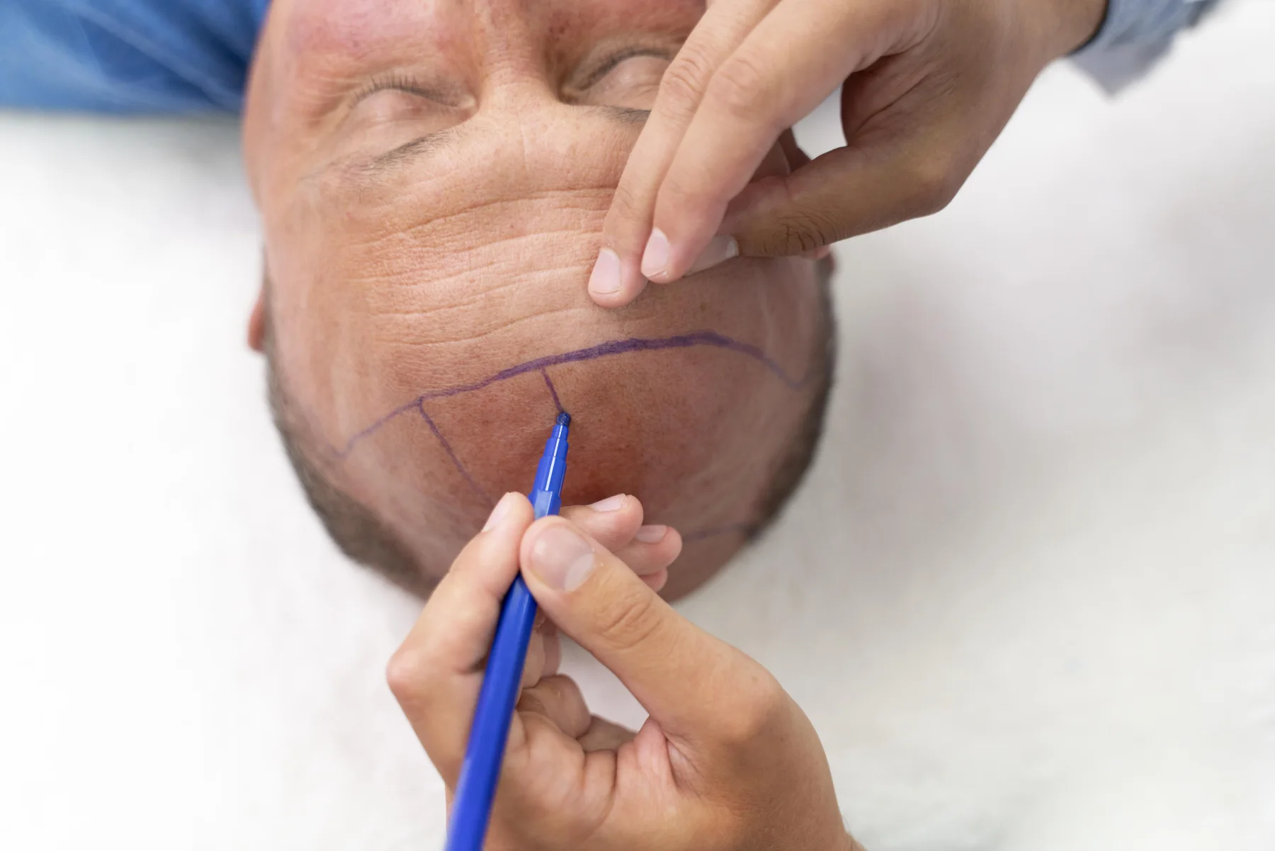 Hair Transplantation
